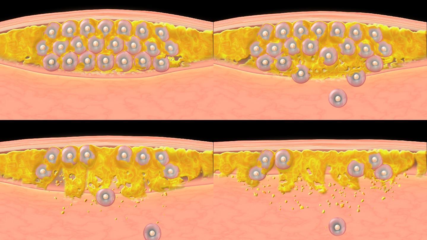 皮肤 细胞 脂肪分解