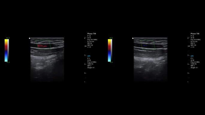 彩超 B超 医学影像 超声检查 视频素材