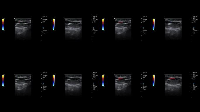 彩超 B超 医学影像 超声检查 视频素材