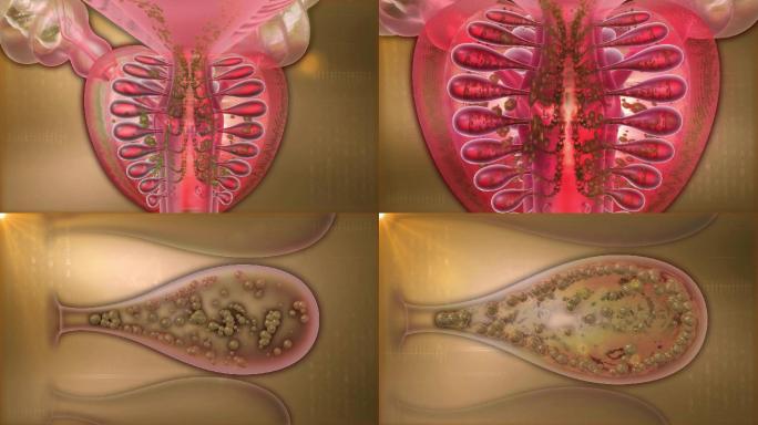 特写前列腺体小管内堆积毒素垃圾形成黄碱毒