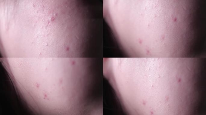 皮肤问题痤疮长痘痘印 (1)