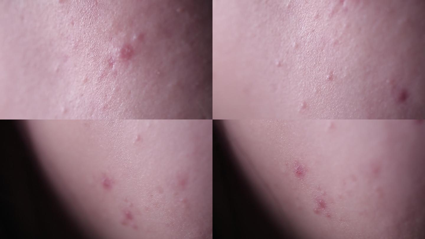 皮肤问题痤疮长痘痘印 (2)