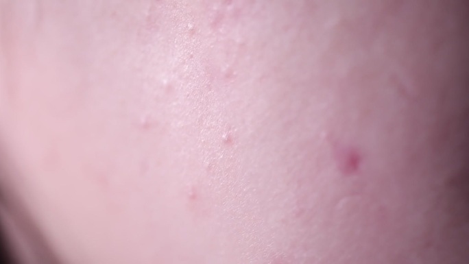 皮肤问题痤疮长痘痘印 (3)