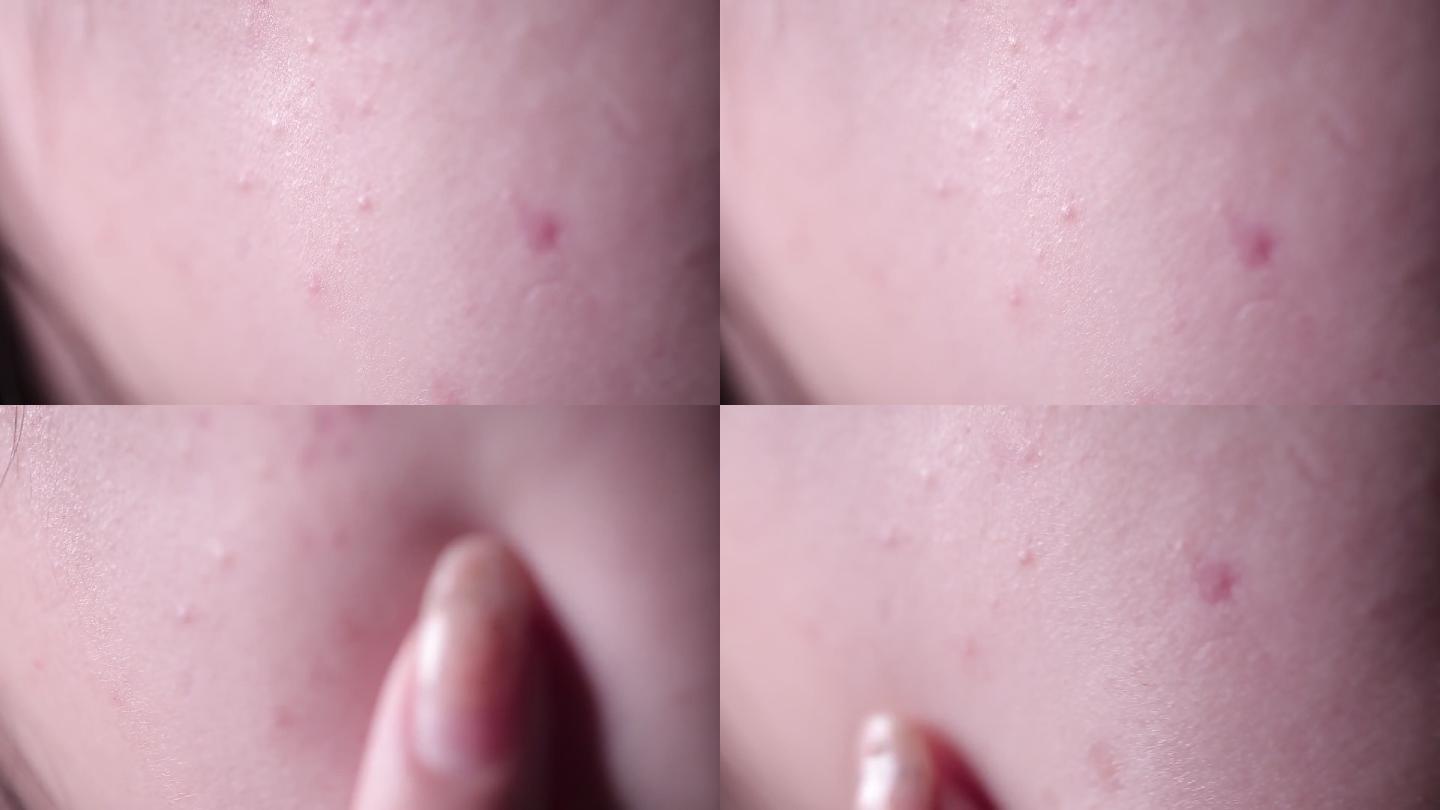 皮肤问题痤疮长痘痘印 (3)
