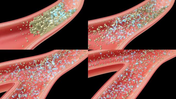 预防硬化_血管剖面