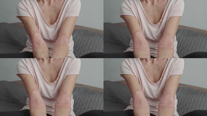 手臂皮肤发炎炎症红肿皮肤病