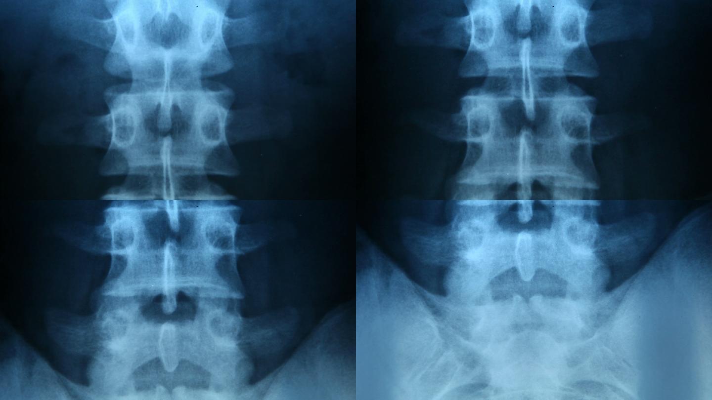 X射线倾斜生物学人体胸腔