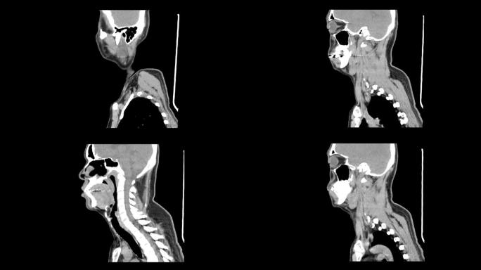 颈部侧位ct扫描