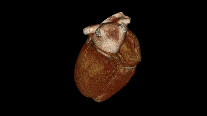 心脏CT血管模型