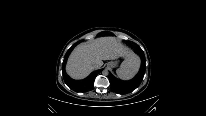 胸部CT扫描单色医学检查