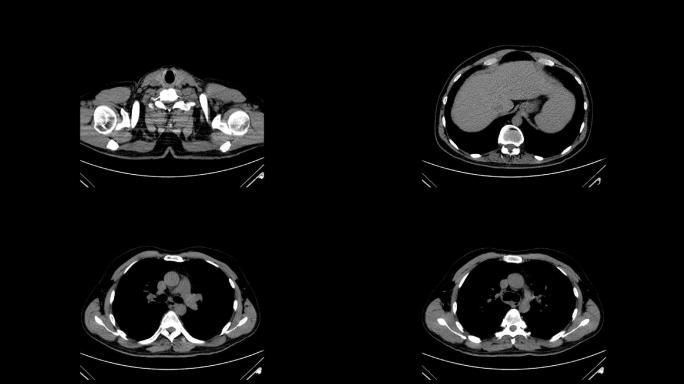 胸部CT扫描单色医学检查