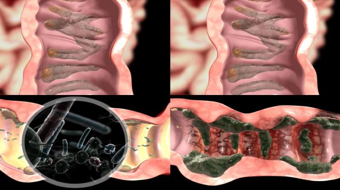 带通道 肠炎 便秘