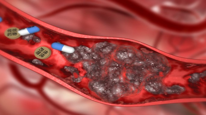 传统药物治疗血栓 血液垃圾 清除血栓