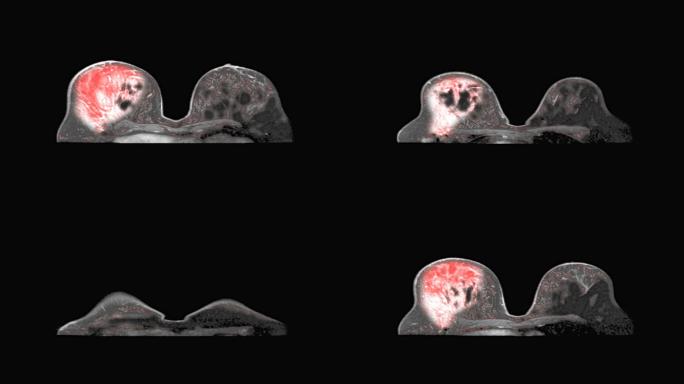 乳腺癌诊断医学MRI扫描监视器