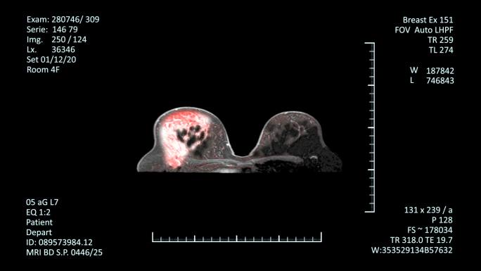 MRI扫描监视器，乳腺癌诊断