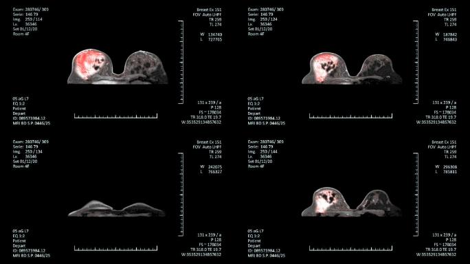 MRI扫描监视器，乳腺癌诊断