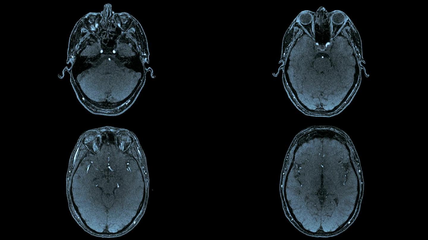 人脑轴向MRI扫描（蓝色调）