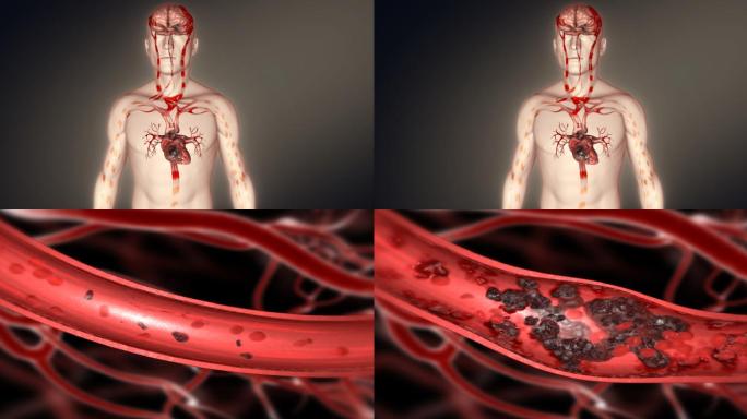 血栓堵塞血管