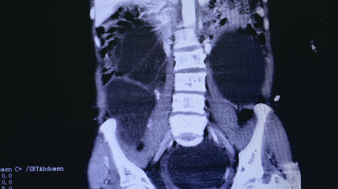 4K腹腔肿瘤术前CT医学影响空镜