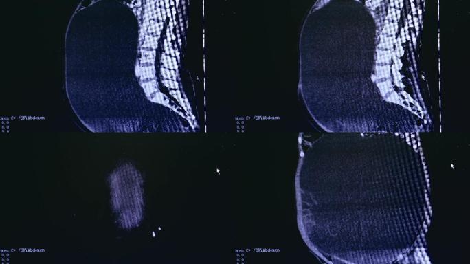 4K腹腔肿瘤术前CT医学影响空镜