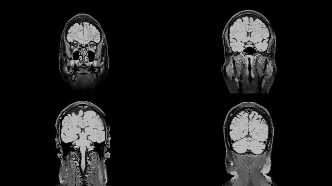 核磁共振脑部扫描，脑部核磁共振成像，