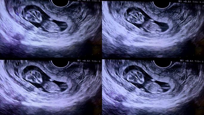 妊娠期间胎儿或婴儿身体的超声扫描
