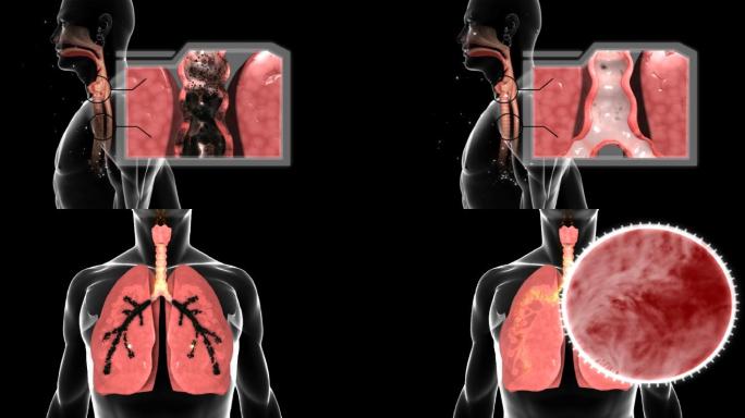 带通道 人体 肺 肺健康 肺部呼吸 肺炎