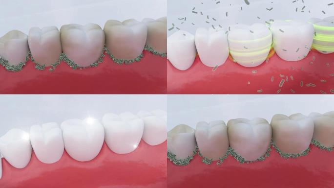 清除牙菌斑 口腔清洁 AE模板