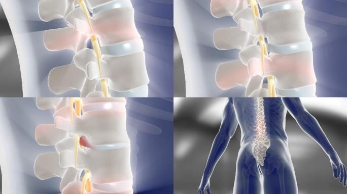 脊柱炎 腰间盘 腰椎 腰矫正