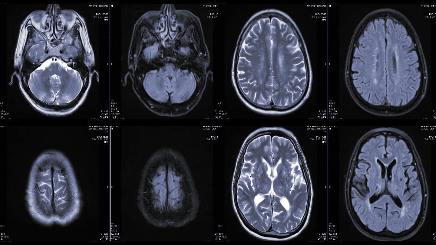 核磁共振脑成像检查结果ct报告脑癌