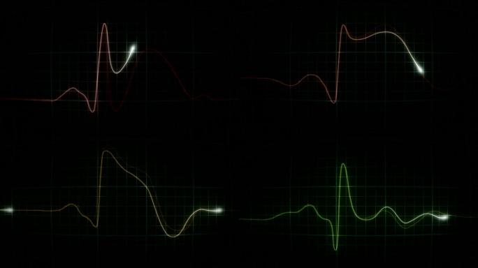 心脏病发作的心电图变化顺序