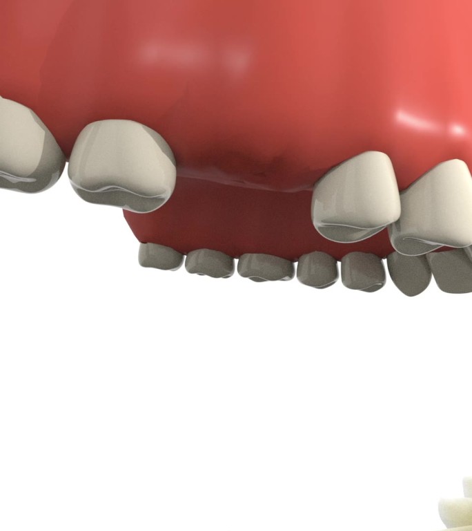 种植牙手术戴导板定位口腔手术动画步骤演示