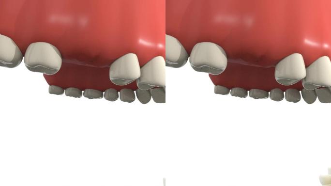 种植牙手术戴导板定位口腔手术动画步骤演示