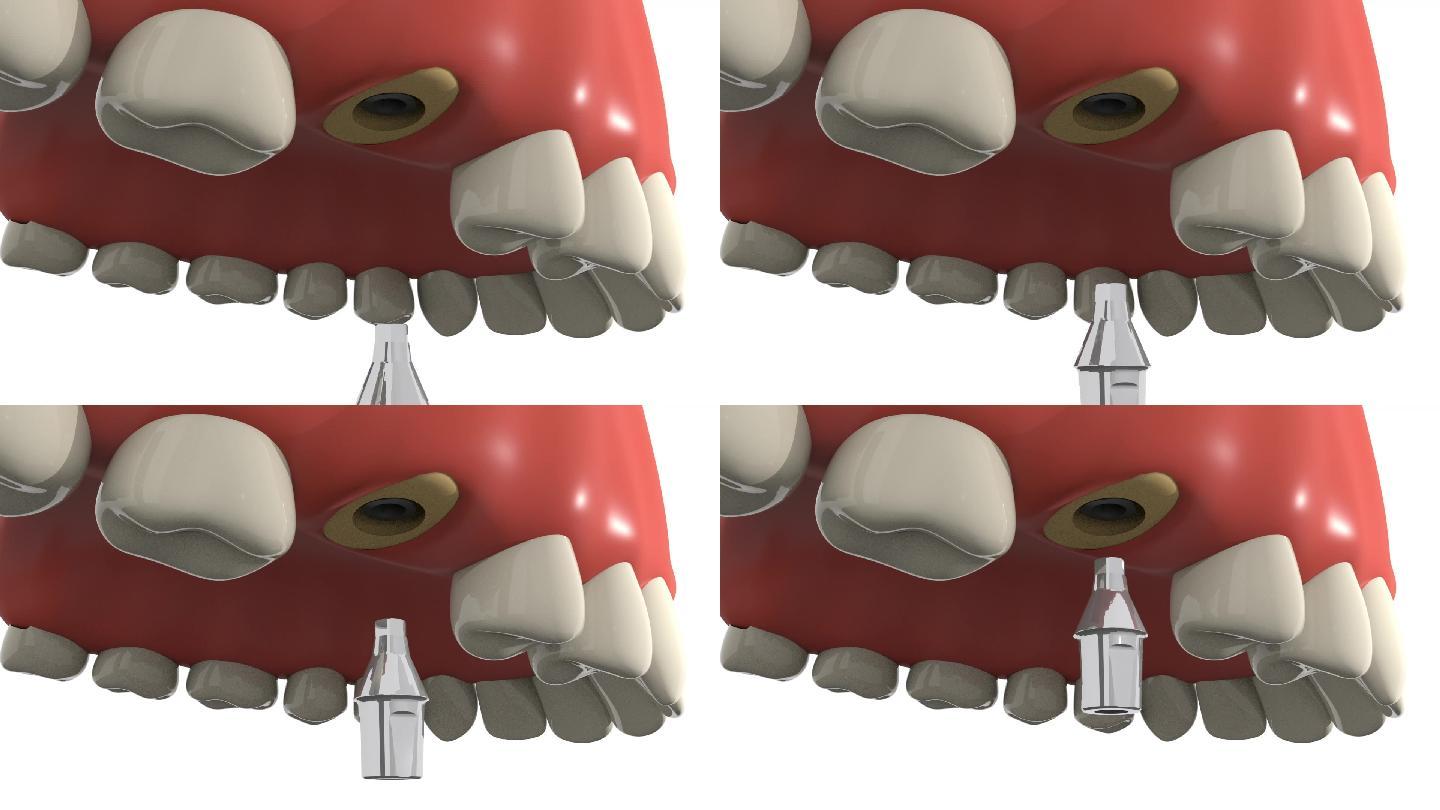 种植牙手术基台安装口腔手术动画步骤演示
