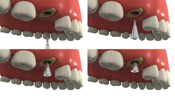 种植牙手术愈合帽安装口腔手术动画步骤演示