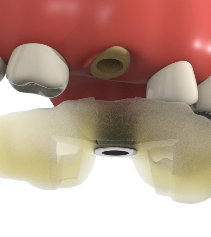 种植牙手术取下导板口腔手术动画步骤演示