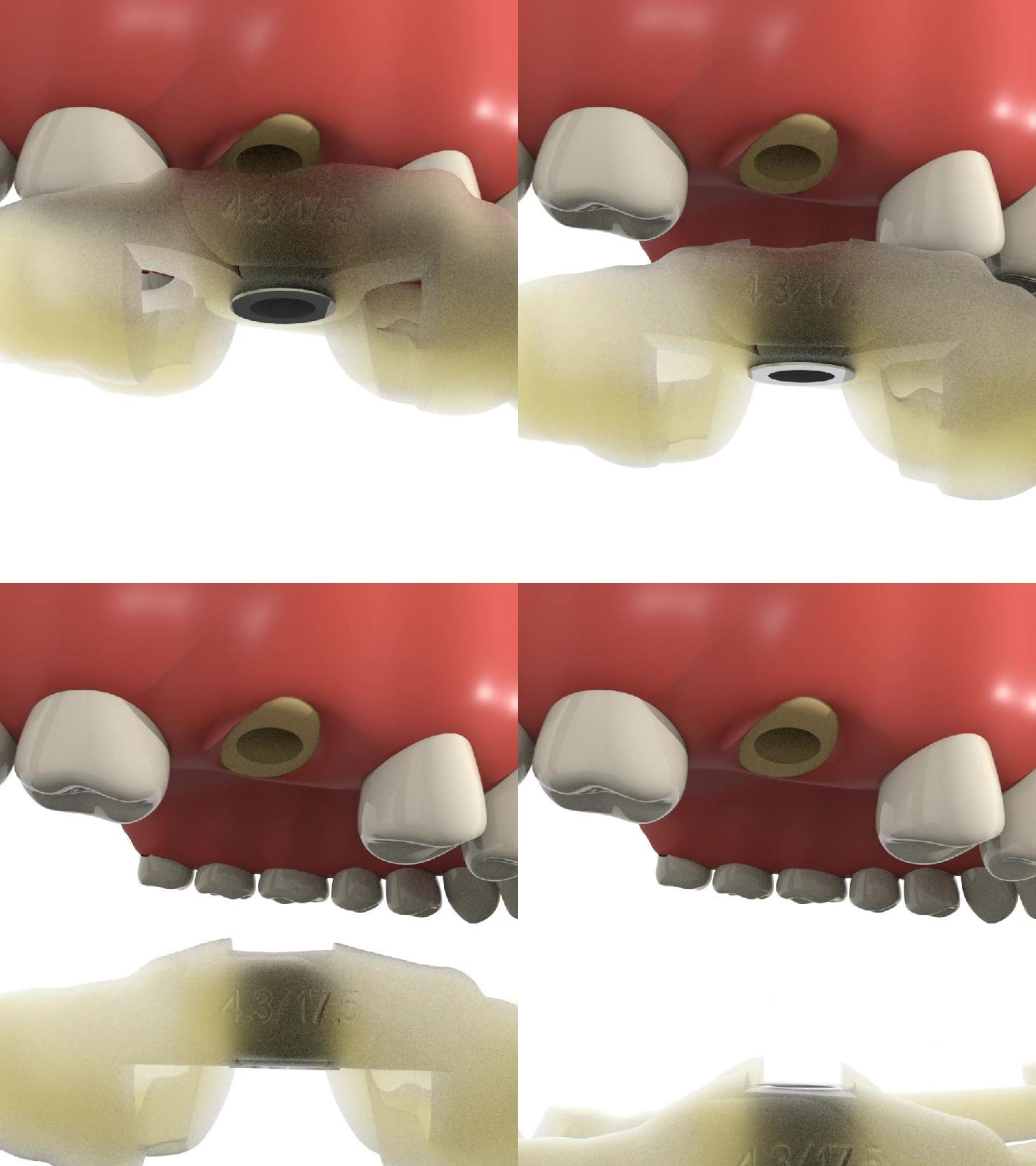 种植手术导板-瑞佳义齿