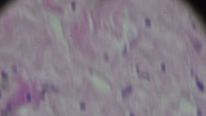 显微镜下的霍奇金细胞病、淋巴瘤