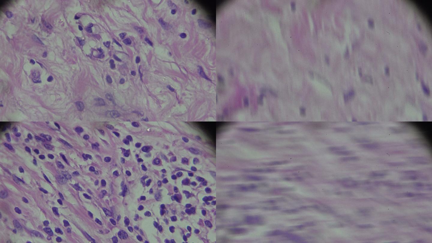 显微镜下的霍奇金细胞病、淋巴瘤