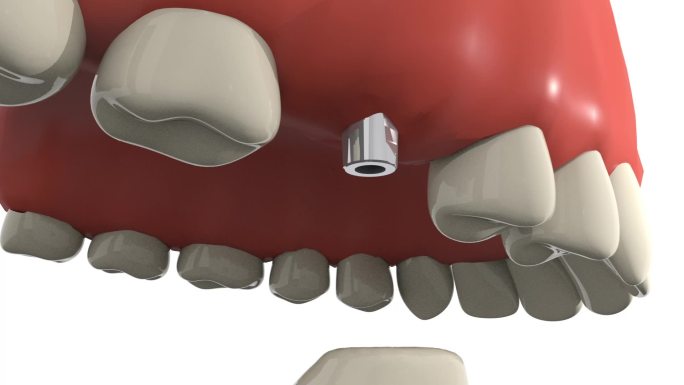 种植牙手术基台安装口腔手术动画步骤演示