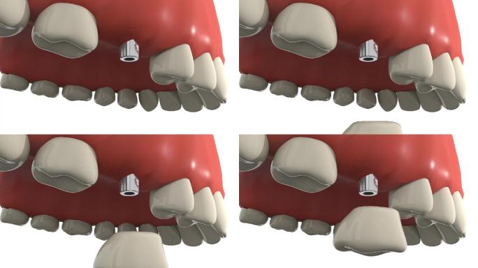种植牙手术基台安装口腔手术动画步骤演示