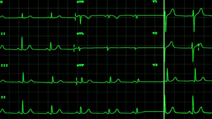有声心脏停止跳动的心电图