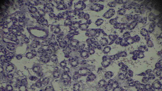 甲状腺癌显微镜下活检