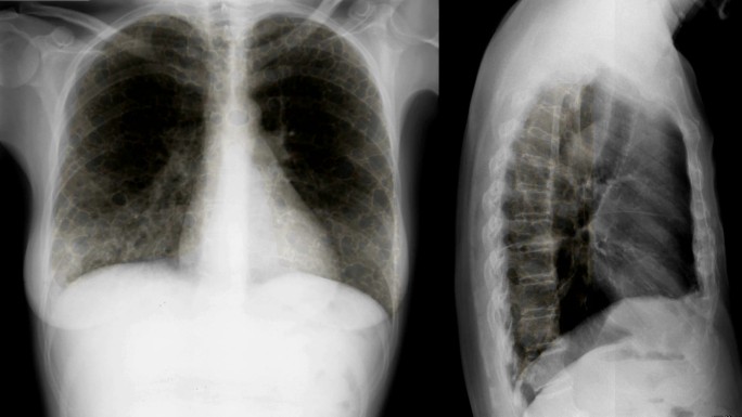 肺部疾病的X线片。