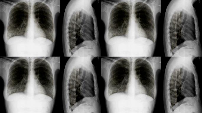 肺部疾病的X线片。