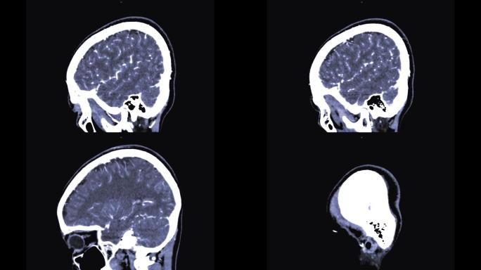 显示人脑血管的3D渲染图像。