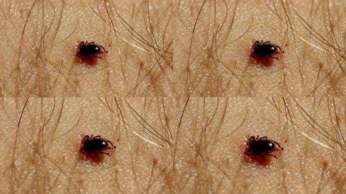蜱虫附着在人类皮肤上，以血液为食