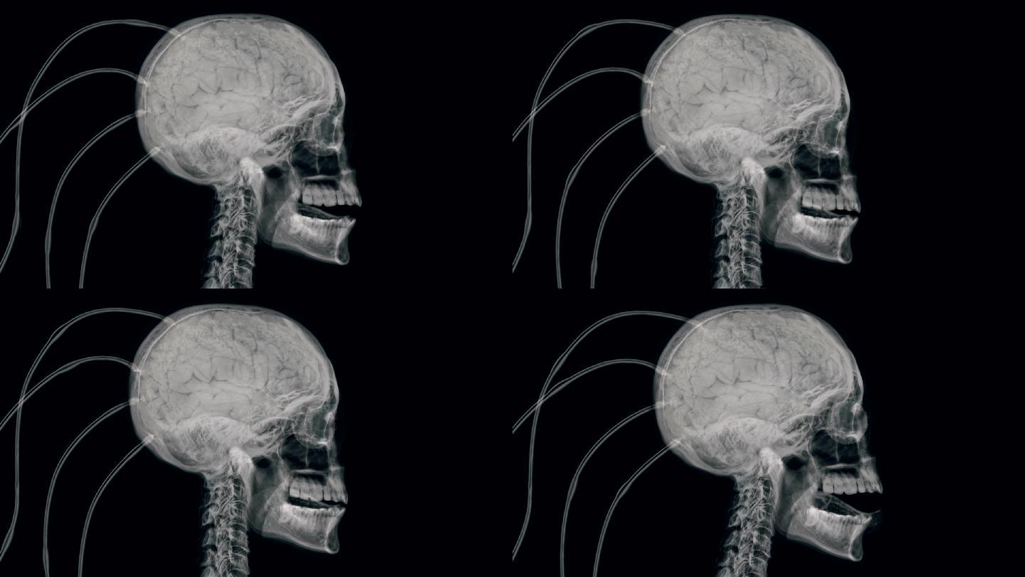 人类大脑实验过程的X射线