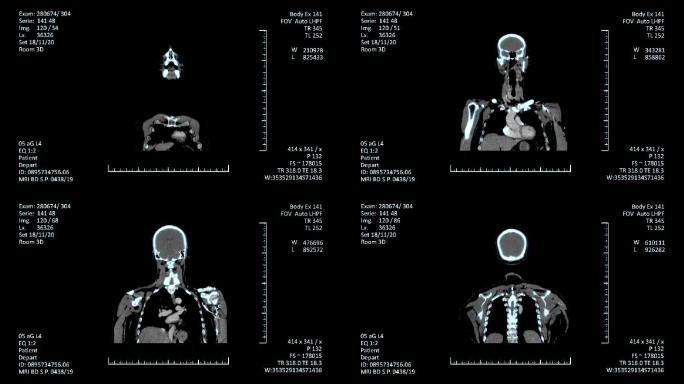 医学MRI扫描屏幕