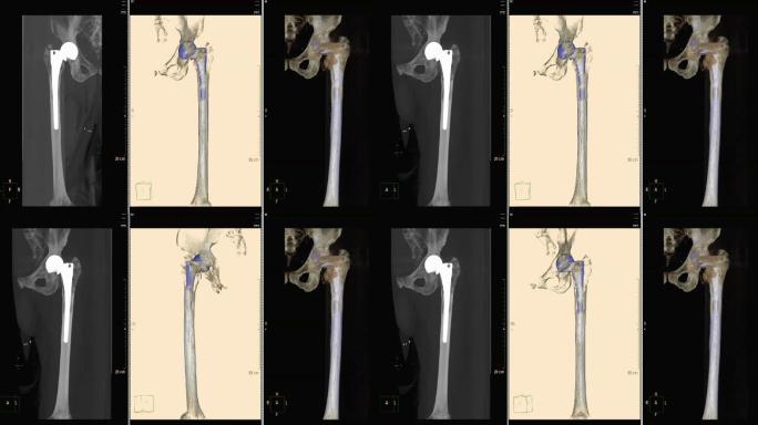 骨盆/髋骨三维渲染图像的CT扫描图像。